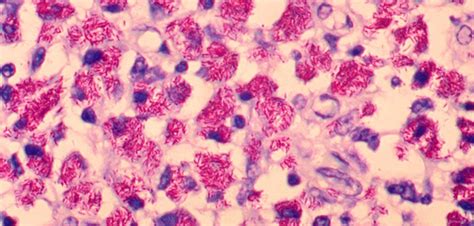 Mycobacterium avium complex lung disease | UT Health North Campus Tyler