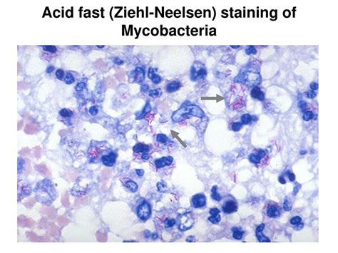 Acid Fast Staining Mycobacterium Tuberculosis