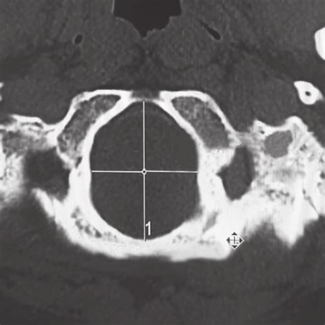 Measurement of foramen magnum sagittal diameter and foramen magnum ...