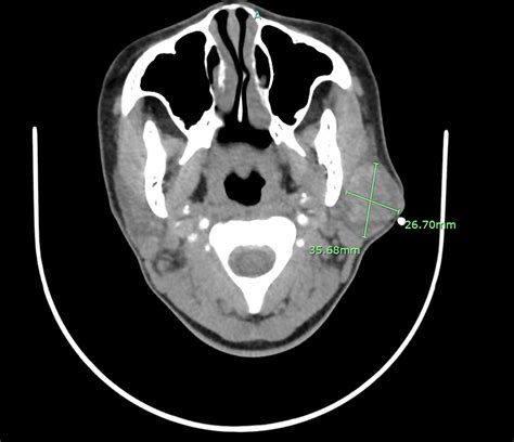 Crosssectional Imaging Of Parotid Gland Nodules A Brief Practical