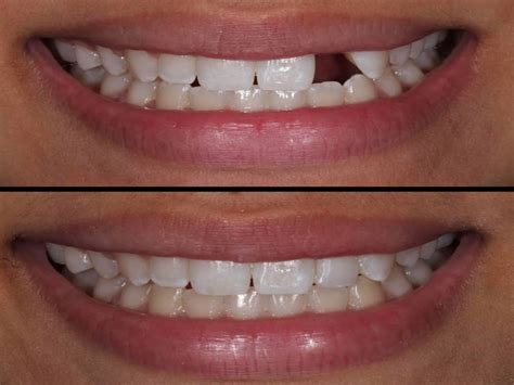 Teeth Gap Closure Treatment Delhi India Cost of Teeth Gap Filling ...