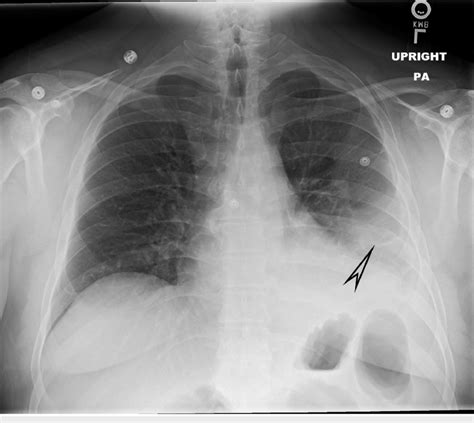 Chest X-ray highlighting a patchy infiltrate in the left lower lobe... | Download Scientific Diagram