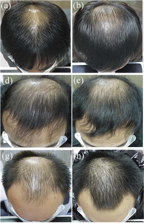 Finasteride Results: Timeline, Photos, Before & After