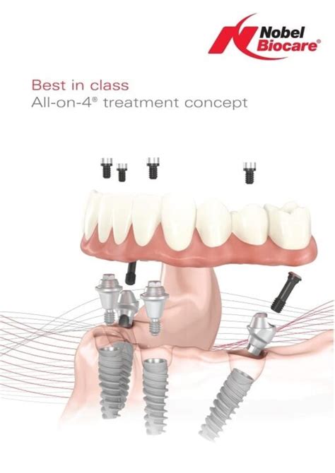 Nobel Biocare All-on-4 Dental Implants in Bangkok, Thailand