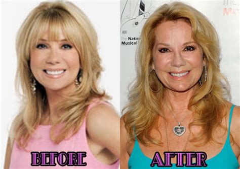 Kathie Lee Gifford Plastic Surgery Before And After Photos