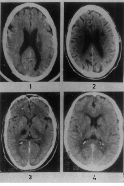 Pattern of infarction: (1) type A corona radiata involving the middle ...