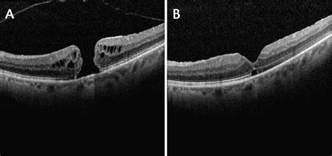 Innovations in Macular Hole Repair - Eyedolatry