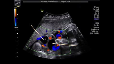 A Gallery of High-Resolution, Ultrasound, Color Doppler & 3D Images - Umbilical cord