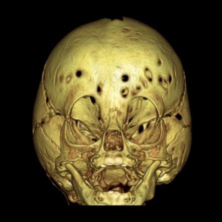 Copper beaten skull | Skull, Cat skull, Pediatric radiology