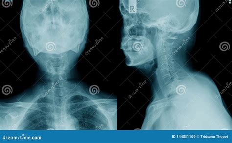 X-ray C-spine, Case Cervical Spondylosis Stock Image - Image of ...