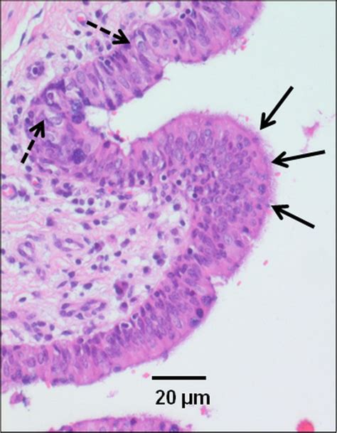 Histological section of the bronchogenic cyst wall of a... | Download ...