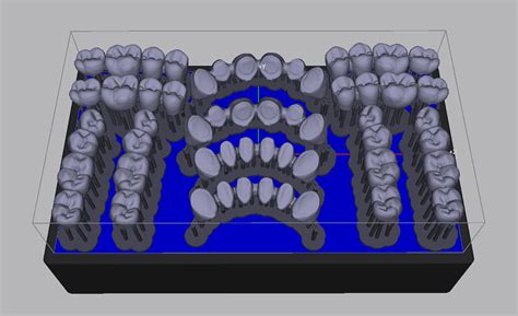 3D Printed Digital Dentures - Silcox Dental Supply