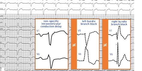 Non-specific intraventricular conduction delay | Cardiocases