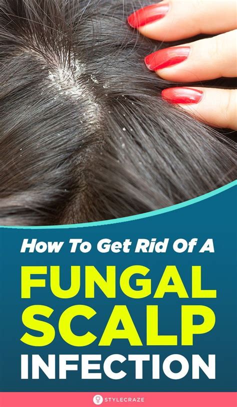 Hair care : How To Get Rid Of A Fungal Scalp Infection | Dry scalp treatment diy, Dry scalp ...