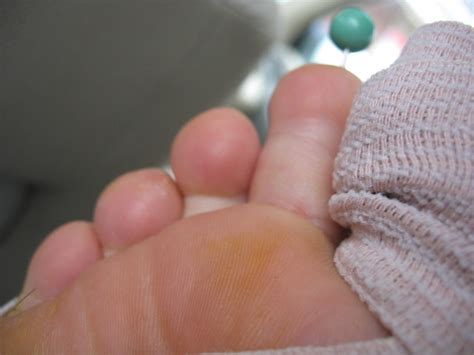 the back of my second toe is swollen | Flickr - Photo Sharing!