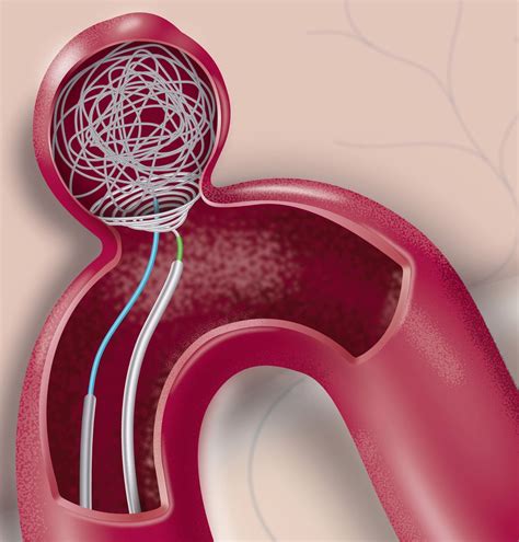 Endovascular treatment of wide-necked intracranial aneurysms using the Nautilus Intrasaccular ...