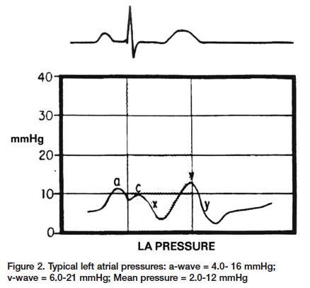 The ABCs of A to V: Right Atrial/ Left Atrial (PCW) Pressures