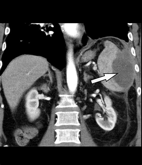 CT-guided percutaneous drainage of a splenic abscess: case report and discussion of diagnostic ...