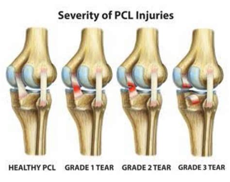 PCL Tear | A+ Orthopaedics & Sports Med Center|New Delhi