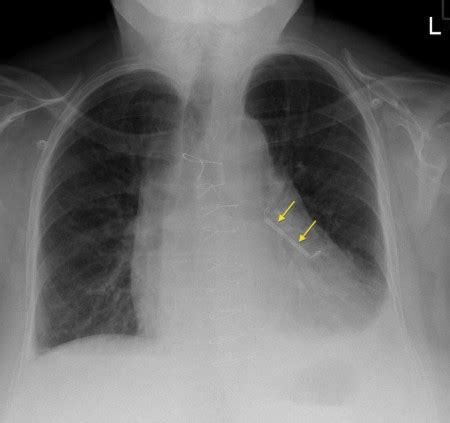 Atrial appendage closure device - Radiology at St. Vincent's University ...