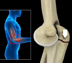 Elbow Fractures NSW | Elbow Joint Pain Treatment NSW