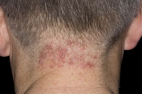 Folliculitis on Head Pictures – 54 Photos & Images / illnessee.com