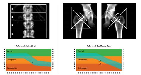 DEXA Scan - Scores & Everything You Need to Know | AlgaeCal