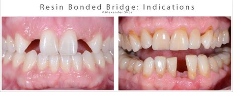 Resin Bonded Bridge: Minimally Invasive Option for Tooth Replacement ...