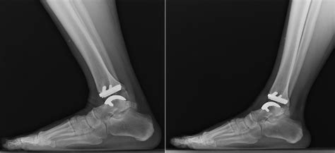 Learn about Total Ankle Replacement,Total Ankle Surgery | total ankle arthroplasty