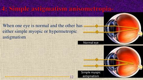 ANISOMETROPIA