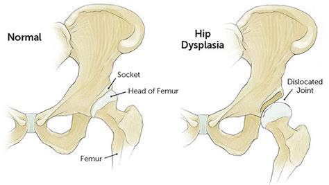 Physiology Of Hip Joint