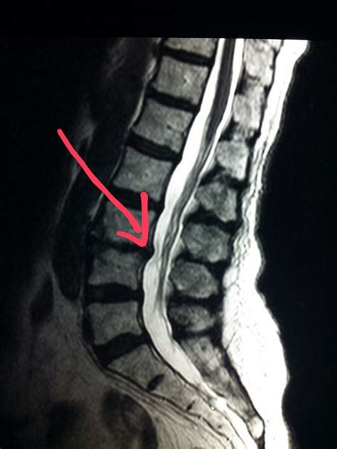 #MRI of the #lumbar #spine shows a #disk #protrusion (#herniation) in someone with #back #pain ...