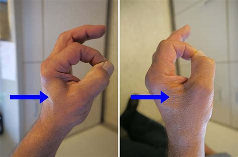 Ulnar Nerve Entrapment at the Elbow (Cubital Tunnel Syndrome ...