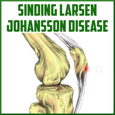 Sinding-Larsen-Johansson Syndrome - Sports Medicine Review