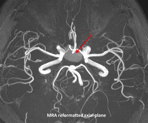 Pituitary apoplexy – Radiology Cases