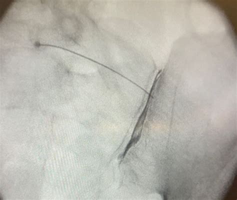 Si joint injection | Page 2 | Student Doctor Network