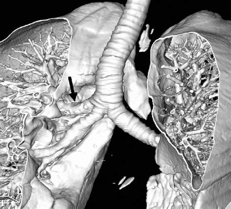 Tracheal bronchus: Right upper lobe bronchus from tracheal bifurcation.... | Download Scientific ...