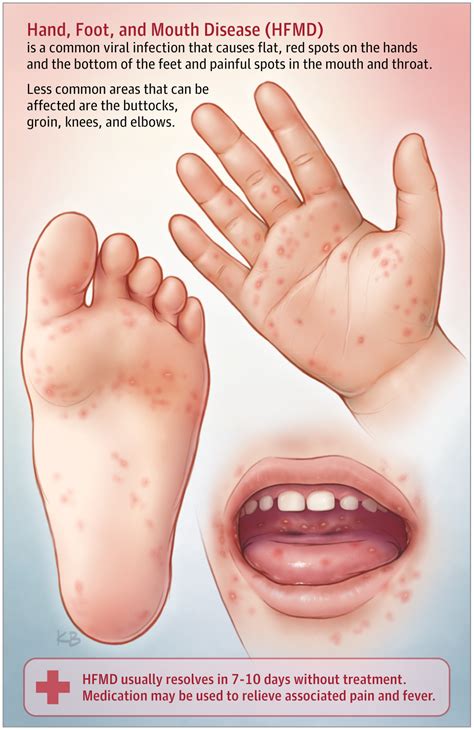 Hand, Foot, and Mouth Disease | Dermatology | JAMA | JAMA Network