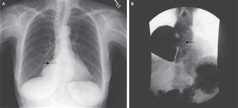 Epiphrenic Diverticulum | NEJM