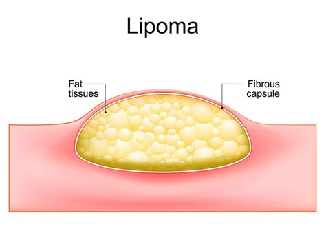 Fatty Lipoma Causes and Treatment | Venice, FL