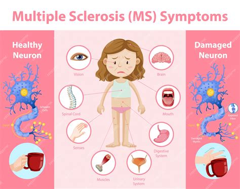 Multiple sclerose (ms) symptomen informatie infographic | Gratis Vector