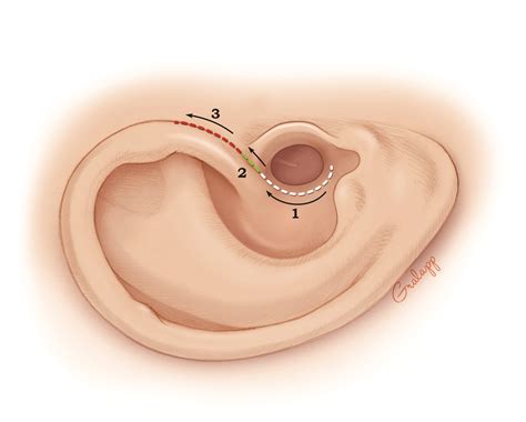 Endaural Incision – Oto Surgery Atlas