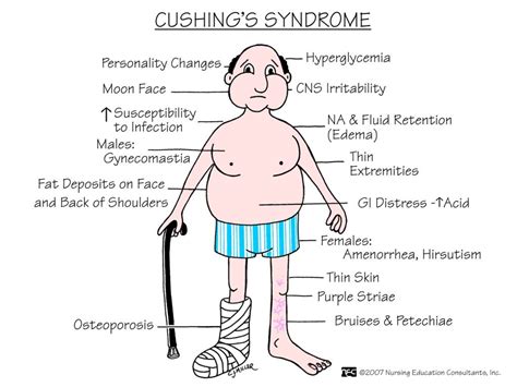 Cushing's Syndrome-ABC Medicine