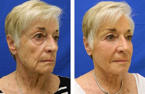 Liquid Facelift Gallery 4 Before and After Photos Connecticut