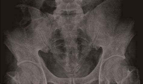 Efficacy of coated metal ureteral stent in the treatment of pelvic lipomatosis induced ...