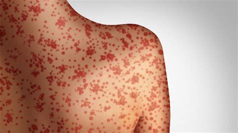 Measles arrives in Florida, what is it and what can you do?