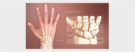 SCAPHOID FRACTURE - MOTUS Physical Therapy