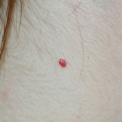 Cherry Angioma - DIY Treatments | London Mole Removal