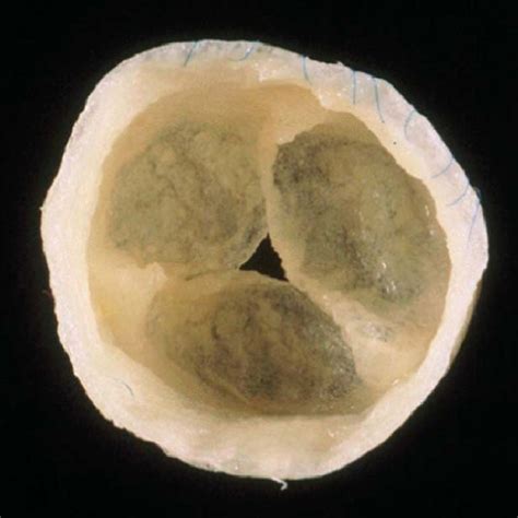 Autologous tissue-engineered heart valves before implantation in an ...