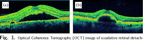 Figure 1 from The mechanics of retinal detachment | Semantic Scholar